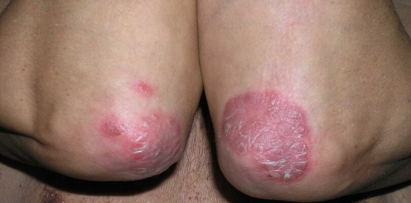 Psoriasis en placas