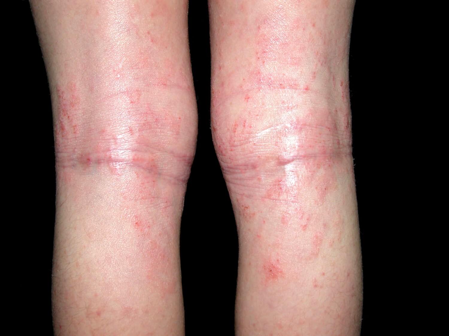 eczema atópico en niños