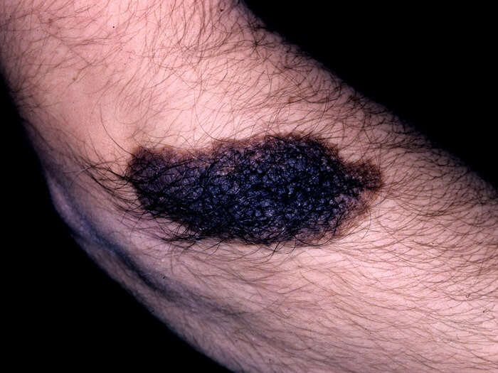 melanoma madrid
