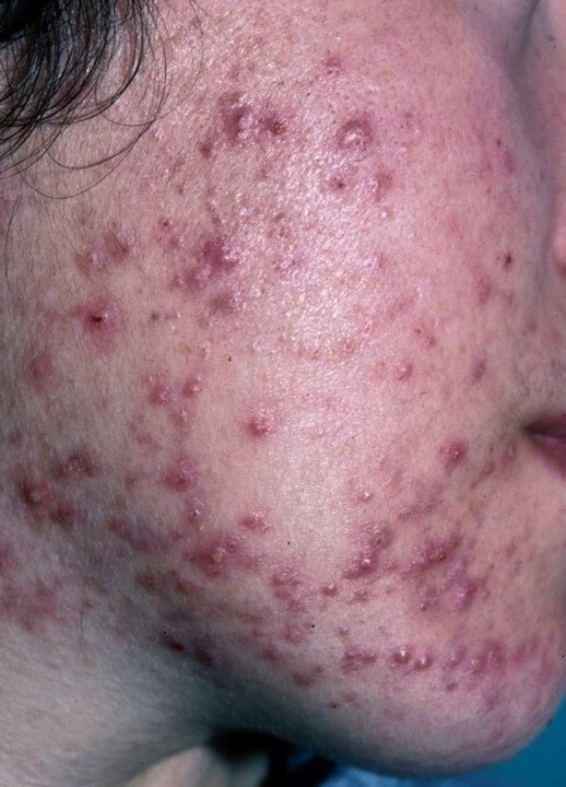 problema de acné madrid