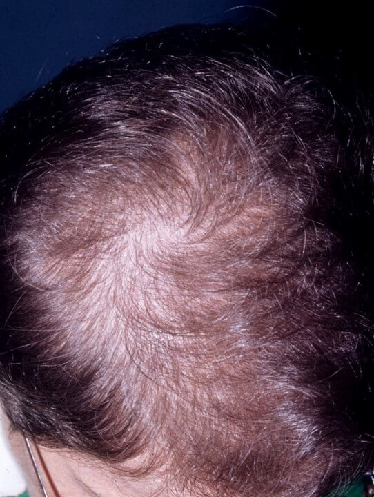 alopecia y cabello