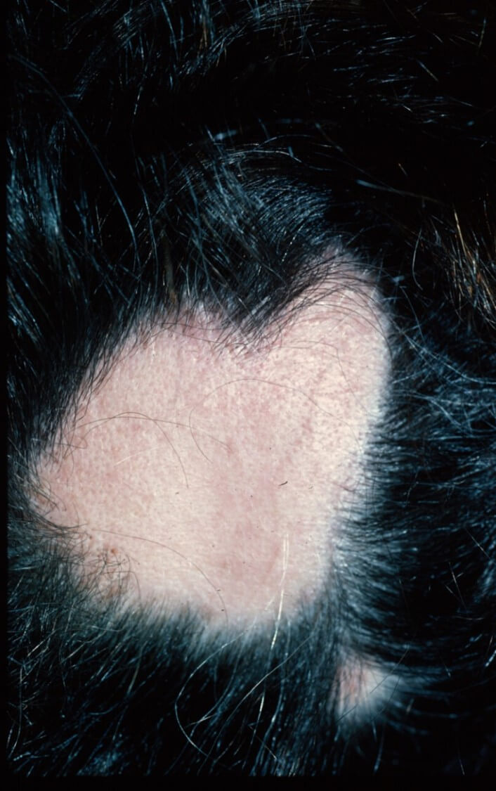 alopecia areata