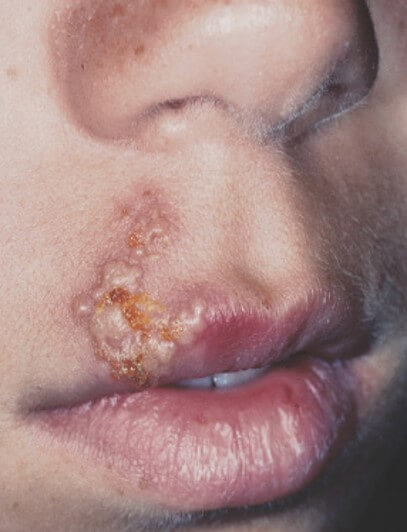 infección por herpes labial