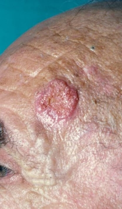 Carcinoma epidermoide